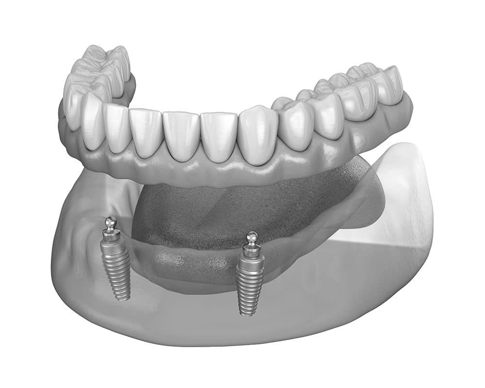 Dental Implants