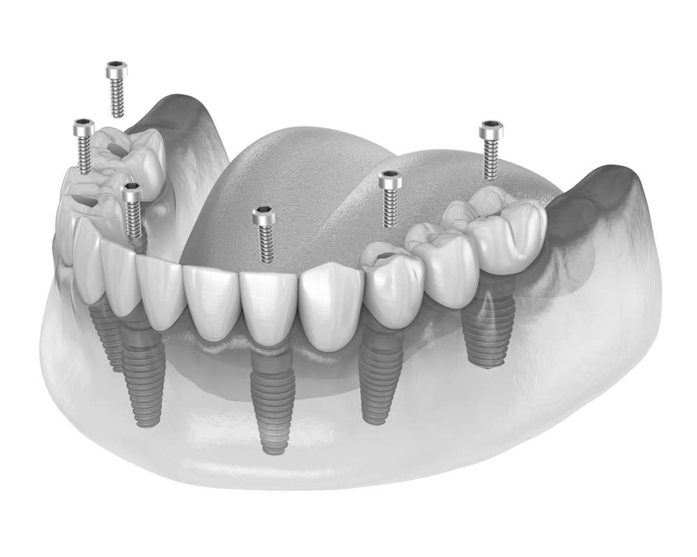 Dental Implants