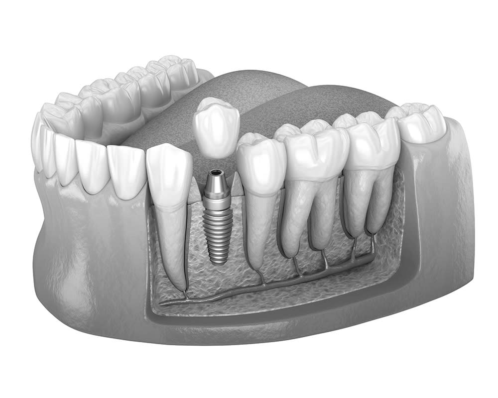 Dental Implants